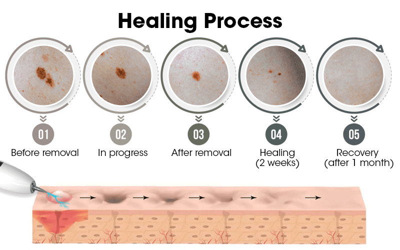 SpotAway Electric Derma Pen